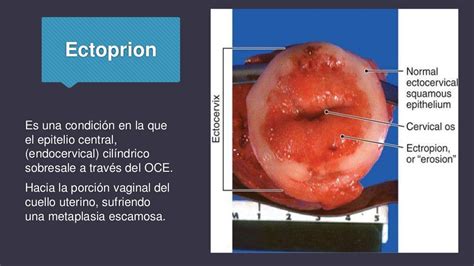 Incompetencia itsmico cervical