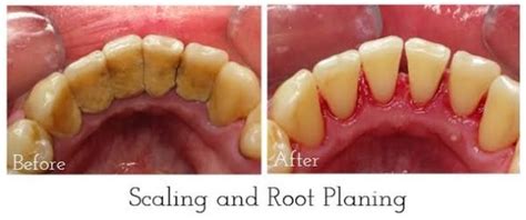 Teeth Scaling Procedure | News | Dentagama