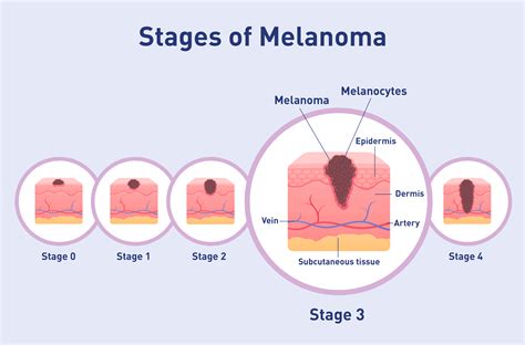 Stage 3 - Melanoma Focus