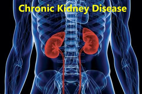 What is Chronic Kidney Disease? - The Mirror | Hear and be Heard