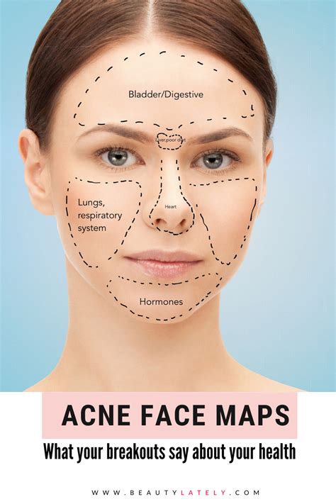 Acne face maps: the reasons behind your breakouts | Face mapping acne, Face acne, Face mapping