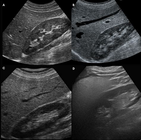 Normal Vs Fatty Liver Ultrasound