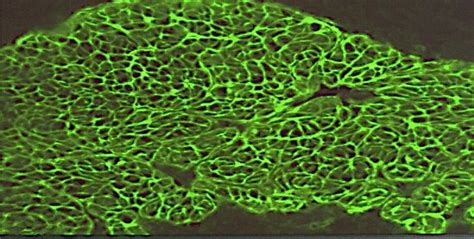 Photomicrograph showing an intense positivity for anti-endomysial ...