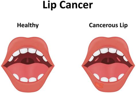 Learn Bump On Inside Of Lip Causes And Treatment Of White Spots | Porn ...