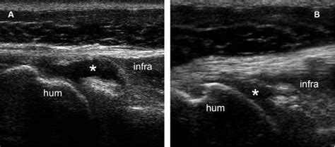 Glenohumeral Joint Ultrasound