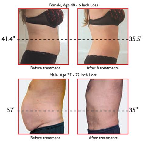 Albuquerque Laser Lipo Weight Loss Clinic | ABQ Laser Lipo