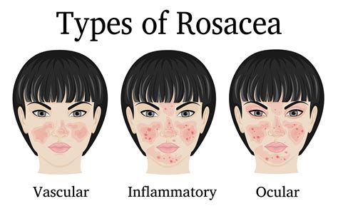 April is rosacea awareness month and we have some top products to help you out - Minihans.ie