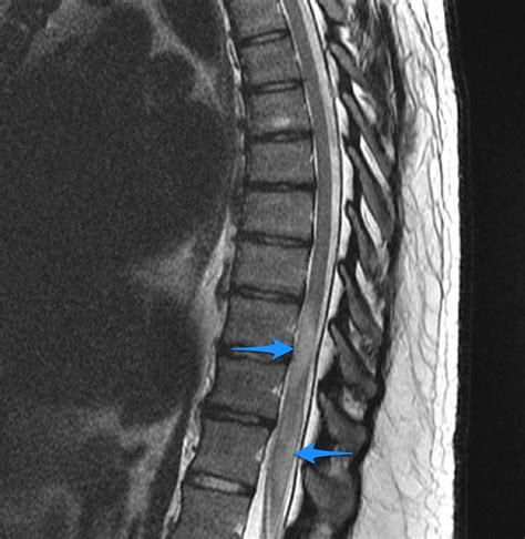 Transverse Myelitis - Causes, Symptoms, Prognosis, Treatment