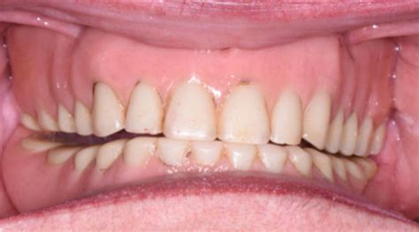 Dentures: procedure, results with before/after photos of dentures