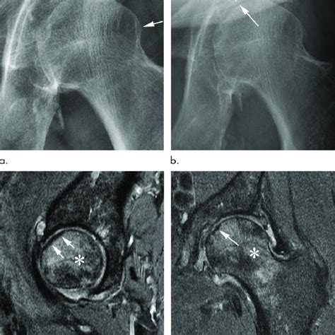 Subchondral insufficiency fracture in a 69-year-old woman who presented... | Download Scientific ...