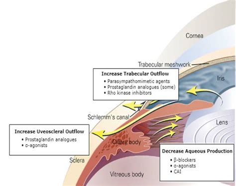 Glaucoma Update: Looking Forward to 2023