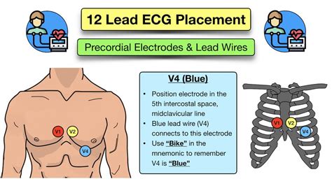 12 Lead ECG Placement: Diagram and Mnemonic for Limb and Precordial Electrode Location — EZmed