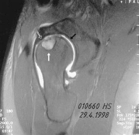 Case 12. Sagittal oblique plane MRI arthrography (gadolinium) of the... | Download Scientific ...