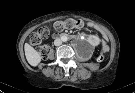 Radiopaedia case Perinephric abscess drainage id: 22397 study: 22433 ...