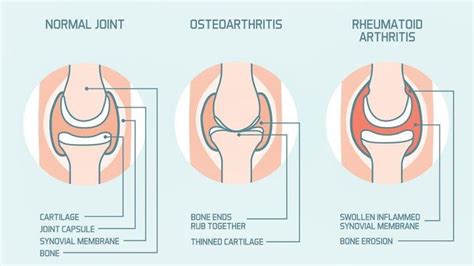 What’s the Difference Between Osteoarthritis and Rheumatoid Arthritis?: Midwest Center for Joint ...