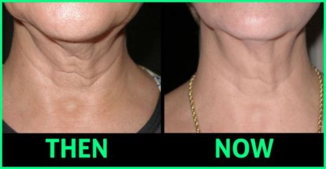 Loose neck skin is something we all encounter, but then, isn’t there a ...