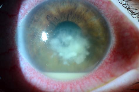 Fungal Corneal Ulcer Satellite Lesion