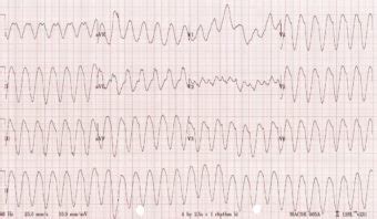 Ventricular Tachycardia – Monomorphic VT • LITFL • ECG Library