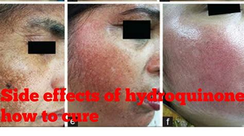 Hydroquinone Cream Side Effects