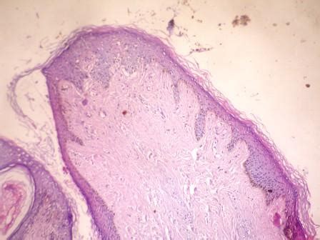 Pathology Outlines - Angiofibroma / fibrous papule