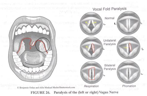 uvula deviation Diagram | Quizlet