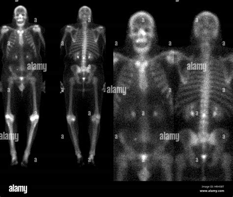 Abnormal bone scan hi-res stock photography and images - Alamy
