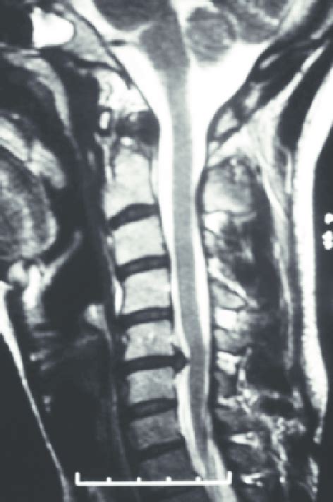 -Case example. Diagnosis of C5-C6 disc herniation in a sagittal T2-MRI... | Download Scientific ...