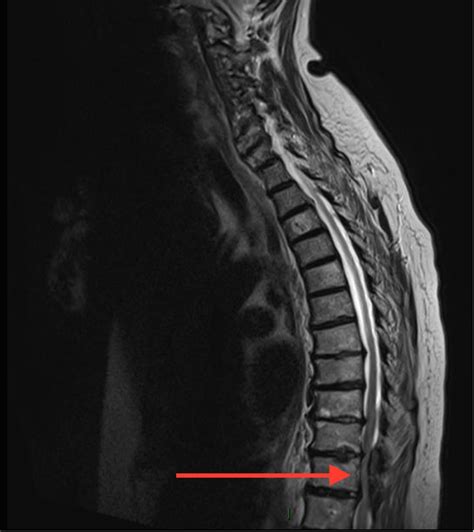 Acute spinal cord compression: a rare complication of dual antiplatelet ...