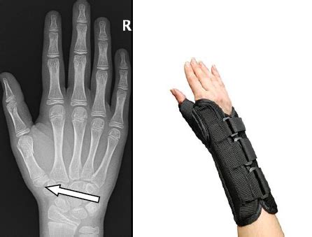 Thumb metacarpal fracture | CUH