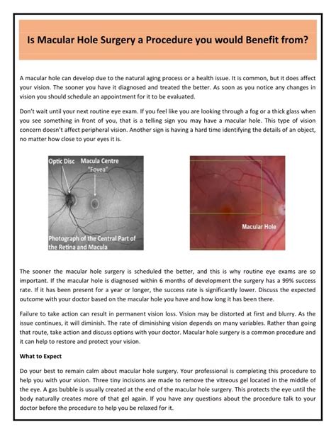 PPT - Is Macular Hole Surgery a Procedure you would Benefit from ...