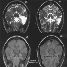 Postoperative magnetic resonance imaging examinations of a temporal... | Download Scientific Diagram