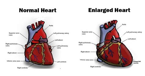 Enlarged Heart (Cardiomegaly): Causes, Treatment, And More, 45% OFF