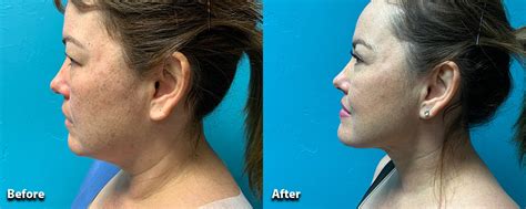 Neck Lift Oklahoma City | Bajaj Plastic Surgery