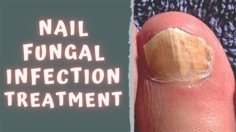 HOW TO TREAT FUNGAL NAIL INFECTION - TINEA UNGUIUM / ONYCHOMYCOSIS ...