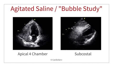 7 Indications for an Echo Bubble Study Cardioserv