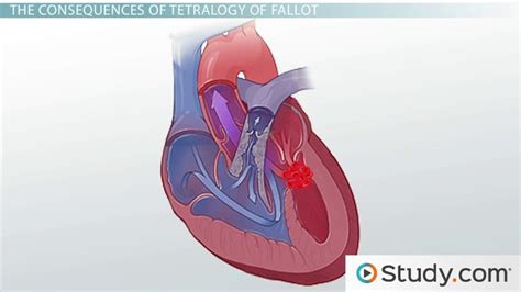 Tetralogy of Fallot: Definition, Causes and Treatment - Lesson | Study.com