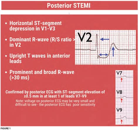 The Reperfusion Guidelines Finally Catch Up - ACEP Now