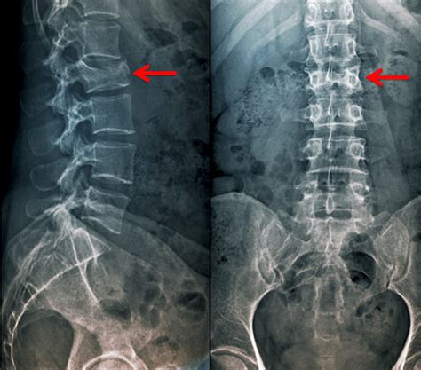 Symptoms Thoracic Wedge Fracture | Easy Health Care Solution - RooHealthCare