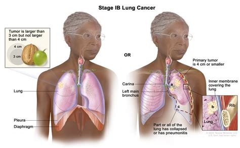 Non-Small Cell Lung Cancer Treatment (PDQ®) - NCI