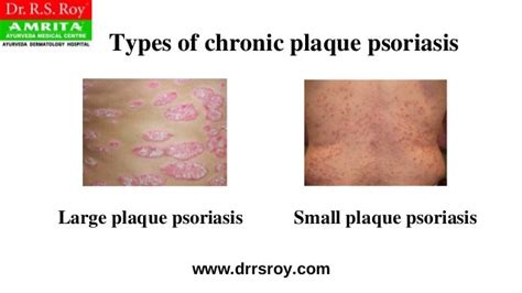 Plaque Psoriasis Treatment In Kochi | Ayurvedic Skin Treatment In Kerala