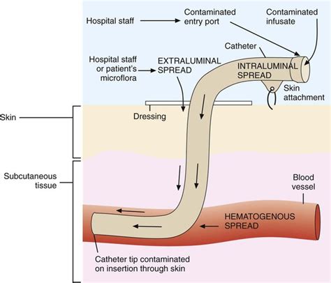 Bloodstream Infections | Clinical Gate