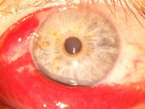 Subconjunctival Haemorrhage | KindSIGHT Eye Specialists