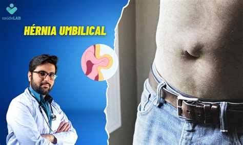 Umbilical Hernia: what are the causes? Is there a way to prevent it? Find out more - SaúdeLab