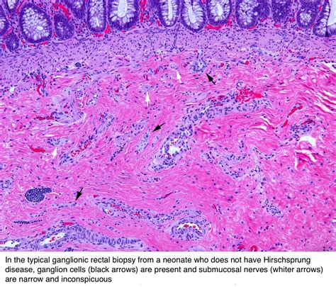 Pathology Outlines - Hirschsprung disease