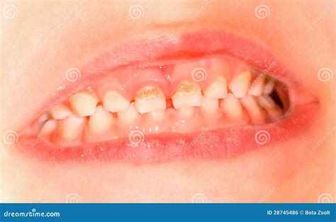 Milk tooth stock photo. Image of teeth, healthy, examine - 28745486