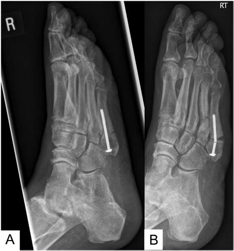 Pseudo Jones Fracture