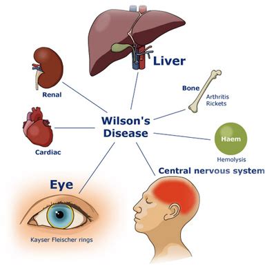 Wilson's Disease: What Are The Causes And Symptoms?