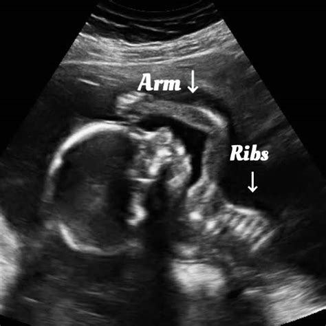 Normal 18 week baby ultrasound. - Ultrasoundfeminsider