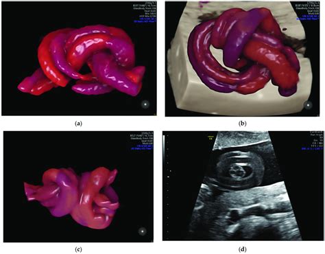 Images of true umbilical knots as (a-c) 3D Static HD Flow imaging and... | Download Scientific ...