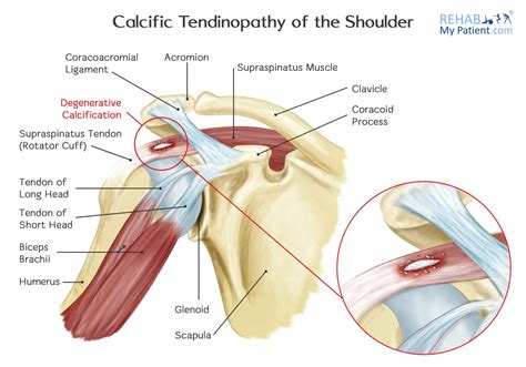 Calcific Tendinopathy of the Shoulder | Rehab My Patient